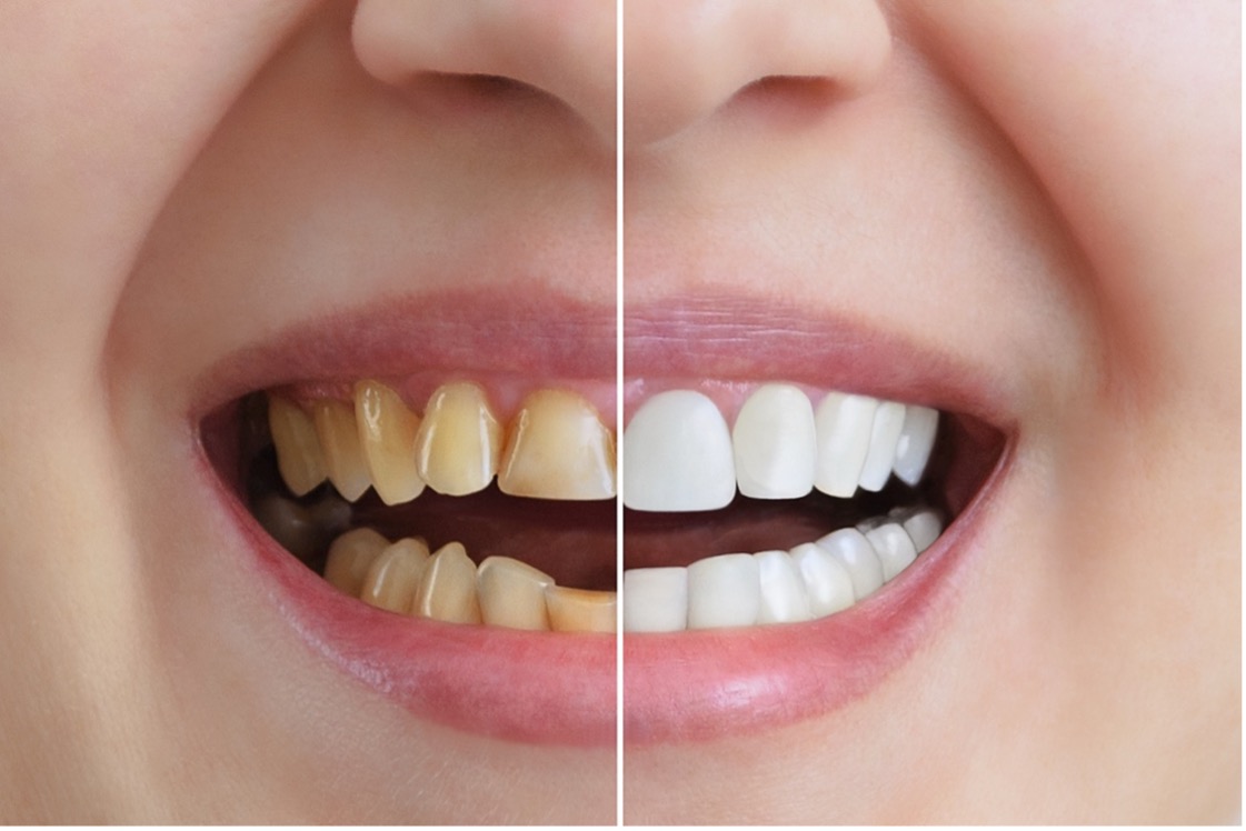 Cosmetic Dentistry Trends: From Whitening to Zirconia Crowns
