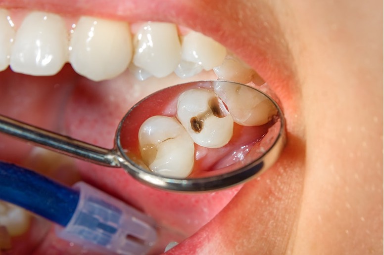 Risk Factors That Threaten Your Smile