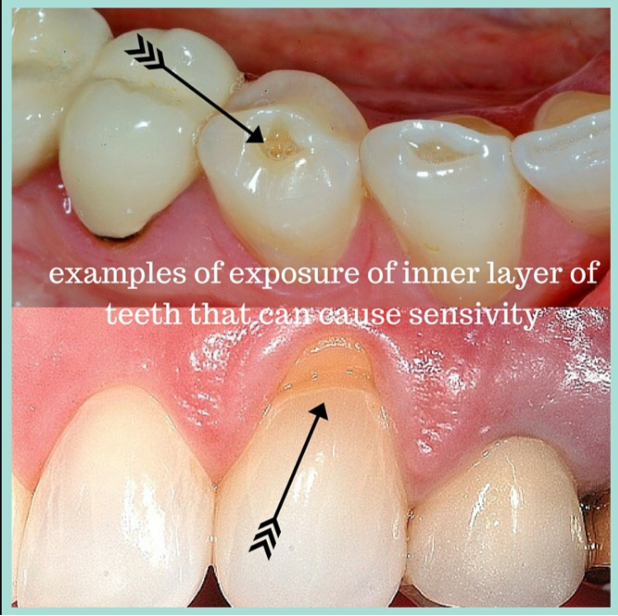 Teeth Sensitivity: Understanding the Causes and Finding Relief