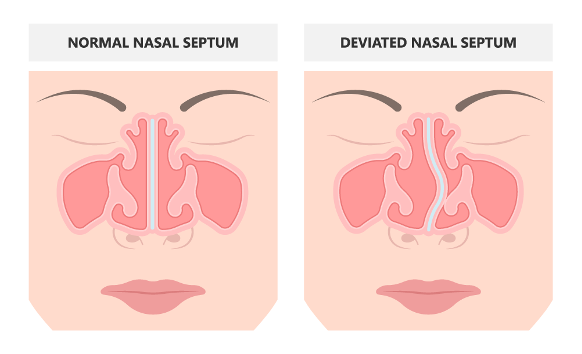 The Surprising Dangers of Mouth Breathing—What No One Told You