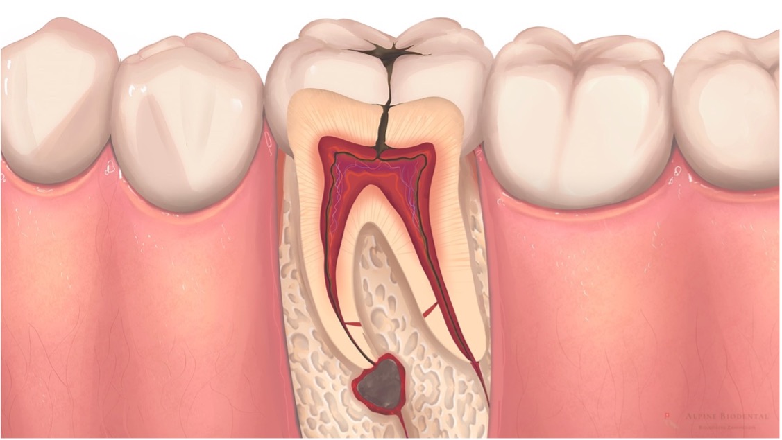 Wisdom Teeth & Root Canals: Understanding the Pain, Process, & Purpose